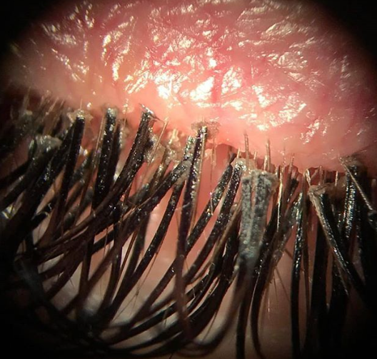Anterior Blepharitis with Lash Extensions